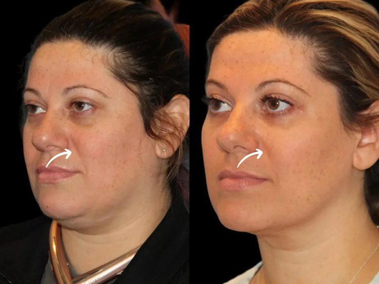 How Many Sculptra Sessions Do You Need? Best Aesthetic Clinic in dubai