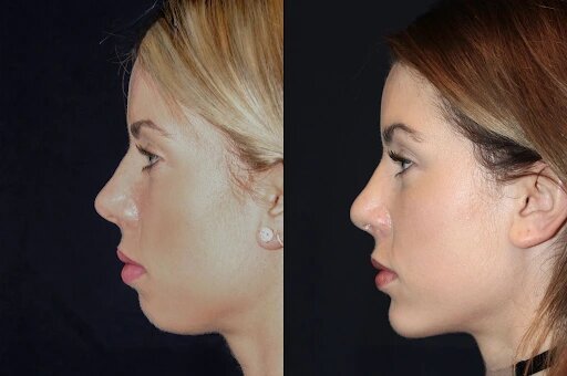 Chin Fillers Treatments in Dubai: Non-Surgical Way to Define Your Chin