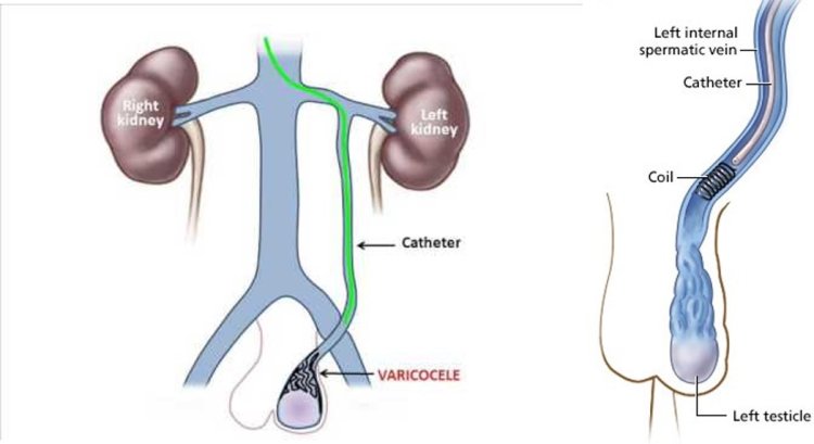 Effective Treatment for Varicocele: Understanding Varicocele Embolisation