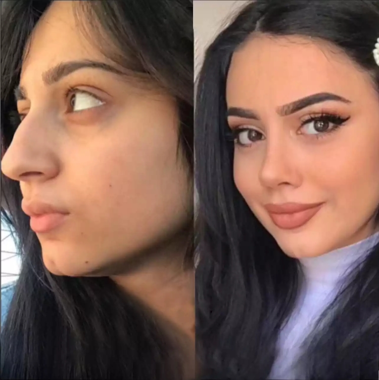 Rhinoplasty in Dubai: Before and After Transformations