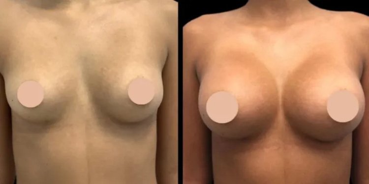 Best Breast Enlargement surgeon in dubai What to Expect During Recovery